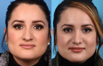 Female patient Rhinoplasty before and after.