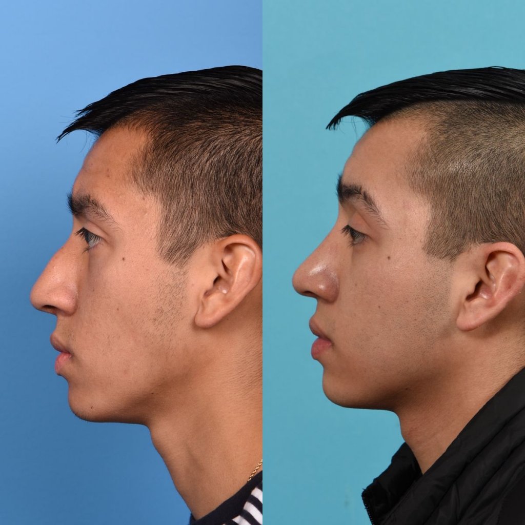Male patient Rhinoplasty before and after.