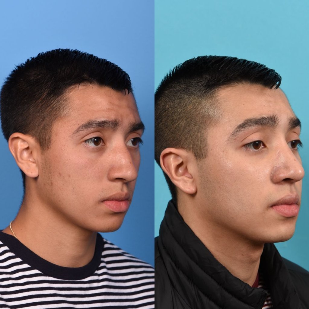 Male patient Rhinoplasty before and after.