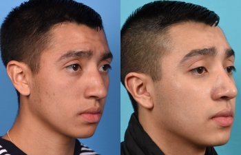 Male patient Rhinoplasty before and after.