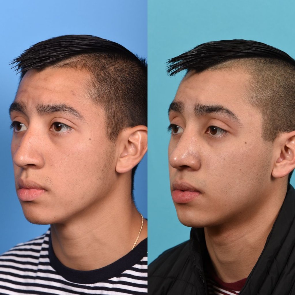 Male patient Rhinoplasty before and after.