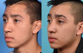Male patient Rhinoplasty before and after.