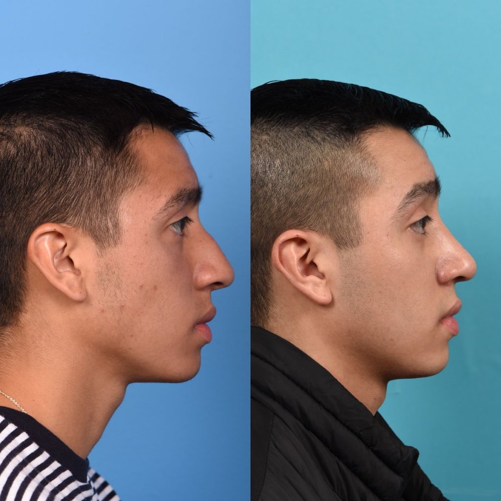 Male patient Rhinoplasty before and after.