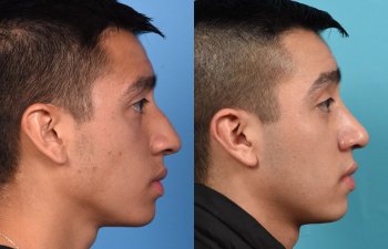 Male patient Rhinoplasty before and after.