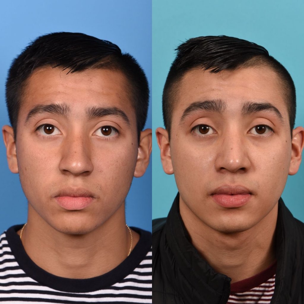 Male patient Rhinoplasty before and after.