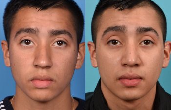 Male patient Rhinoplasty before and after.