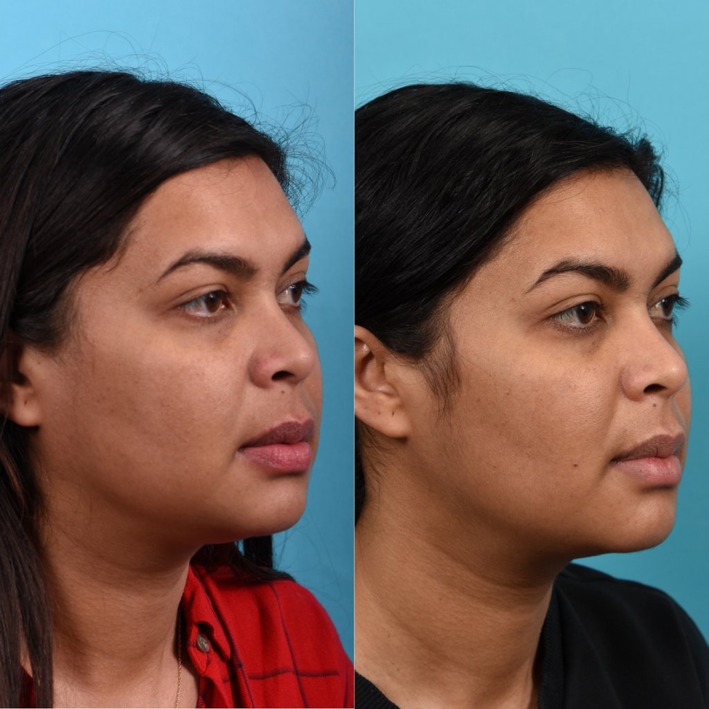 Photos of a woman's face before and after cheek reduction - on the right