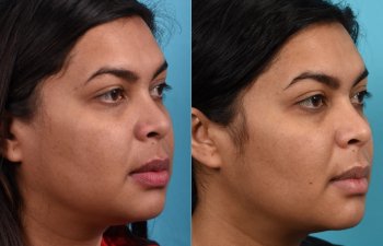 Photos of a woman's face before and after cheek reduction - on the right