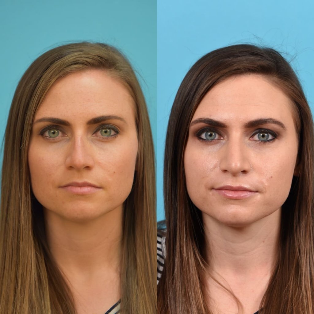 Female patient Rhinoplasty before and after.