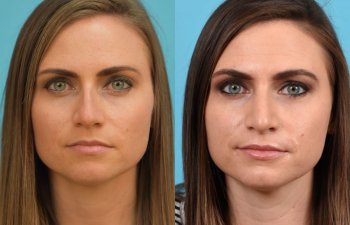 Female patient Rhinoplasty before and after.