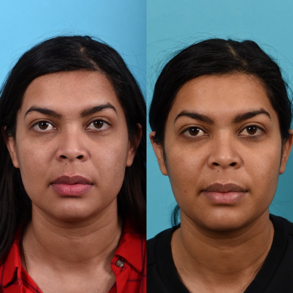 Photos of a woman's face before and after cheek reduction - from the front