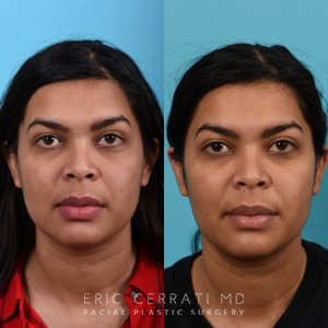 Photos of a woman's face before and after cheek reduction - from the front