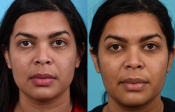 Photos of a woman's face before and after cheek reduction - from the front