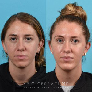 patient before and after chin implant