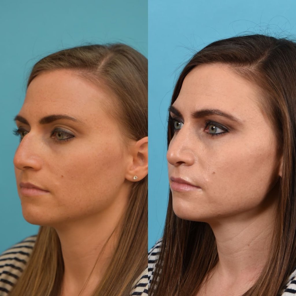 Female patient Rhinoplasty before and after.