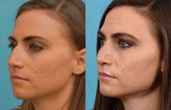 Female patient Rhinoplasty before and after.