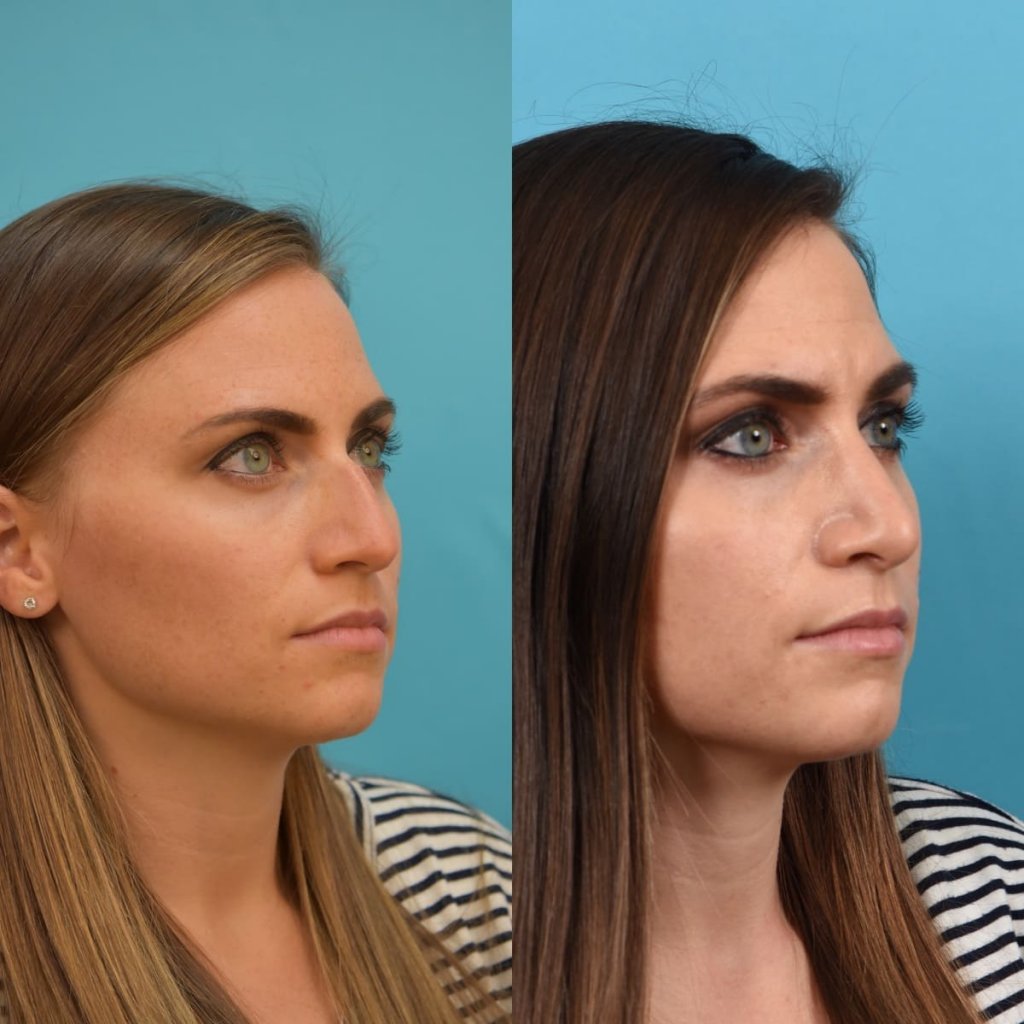 Female patient Rhinoplasty before and after.
