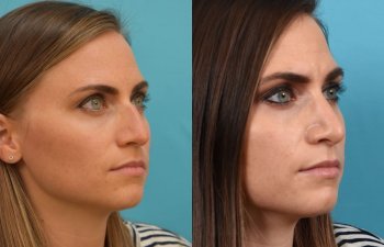 Female patient Rhinoplasty before and after.