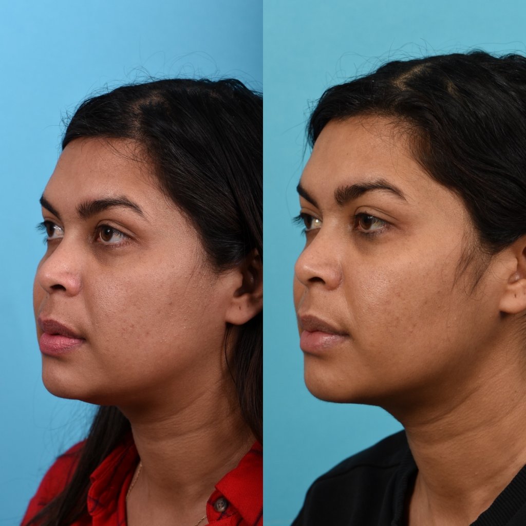 Photos of a woman's face before and after cheek reduction - on the left