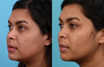 Photos of a woman's face before and after cheek reduction - on the left