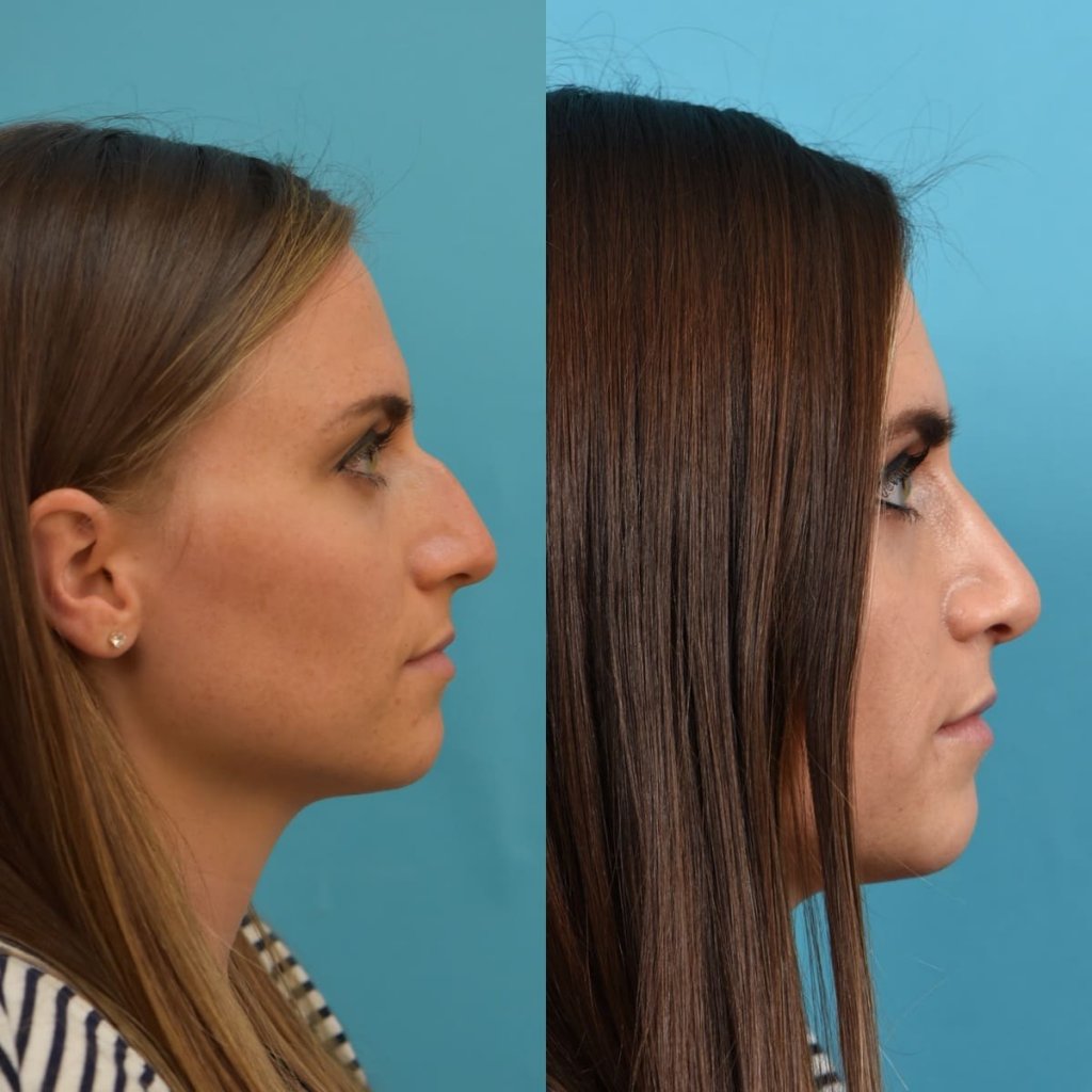 Female patient Rhinoplasty before and after.