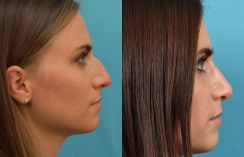 Female patient Rhinoplasty before and after.