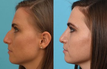 Female patient Rhinoplasty before and after.