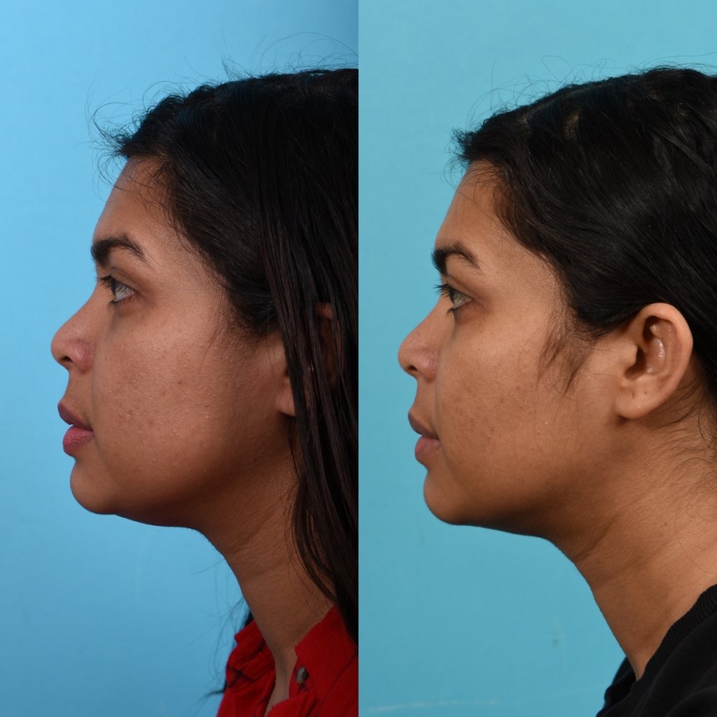 Photos of a woman's face before and after cheek reduction - on the left