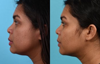 Photos of a woman's face before and after cheek reduction - on the left
