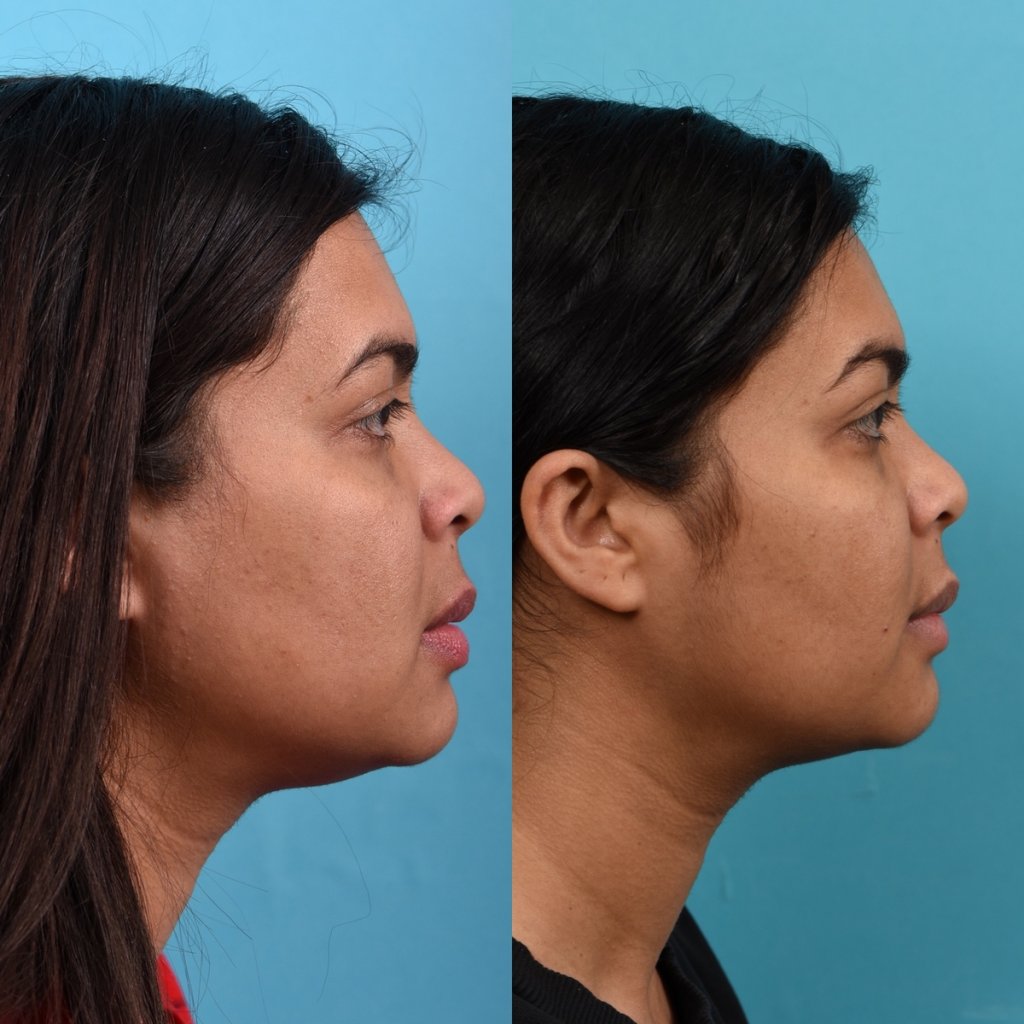 Photos of a woman's face before and after cheek reduction - on the right