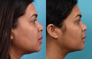 Photos of a woman's face before and after cheek reduction - on the right