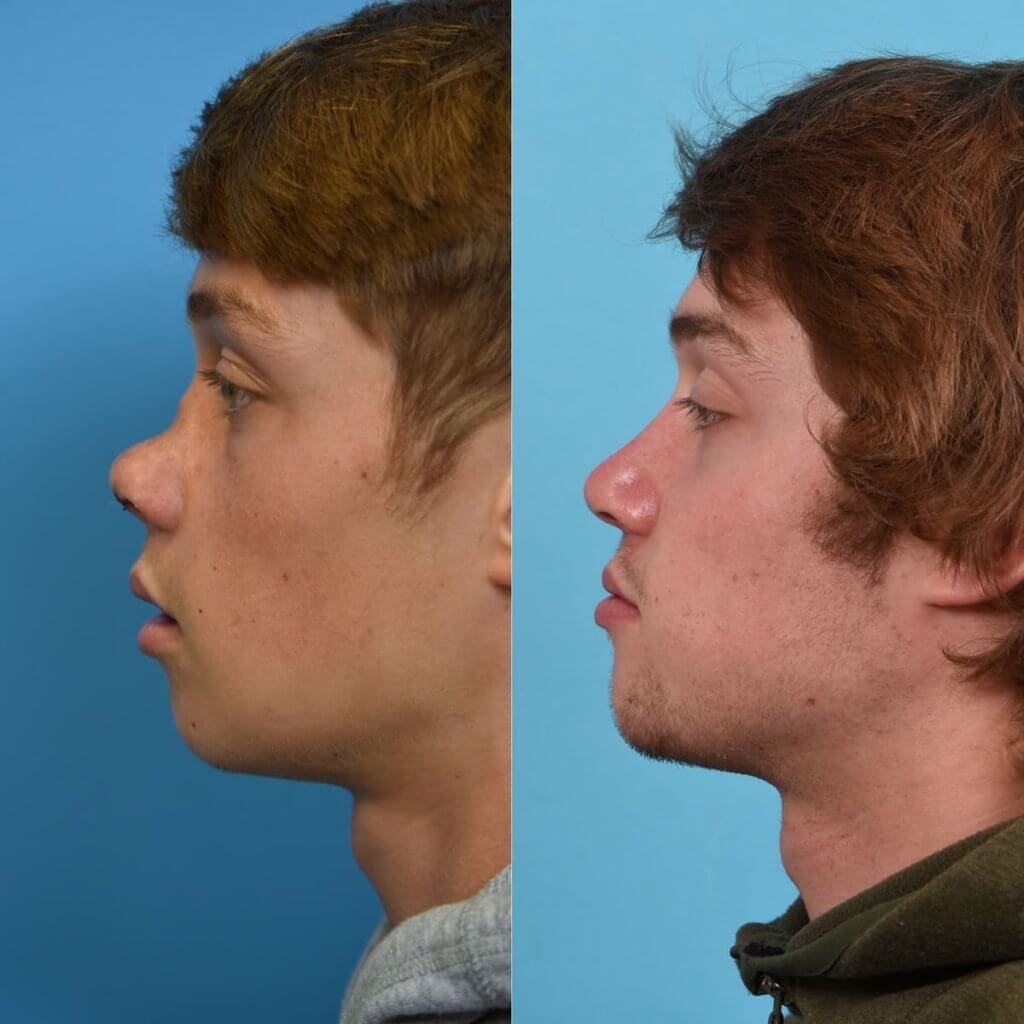 Male patient reconstruction surgery before and after.