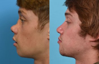 Male patient reconstruction surgery before and after.