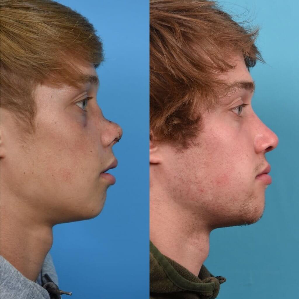 Male patient reconstruction surgery before and after.
