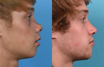 Male patient reconstruction surgery before and after.