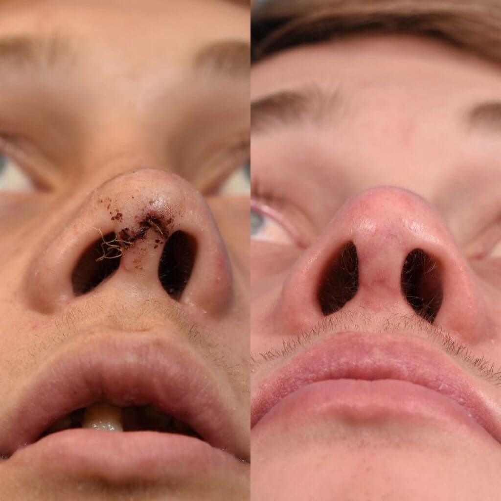 Male patient reconstruction surgery before and after.