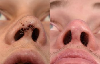 Male patient reconstruction surgery before and after.