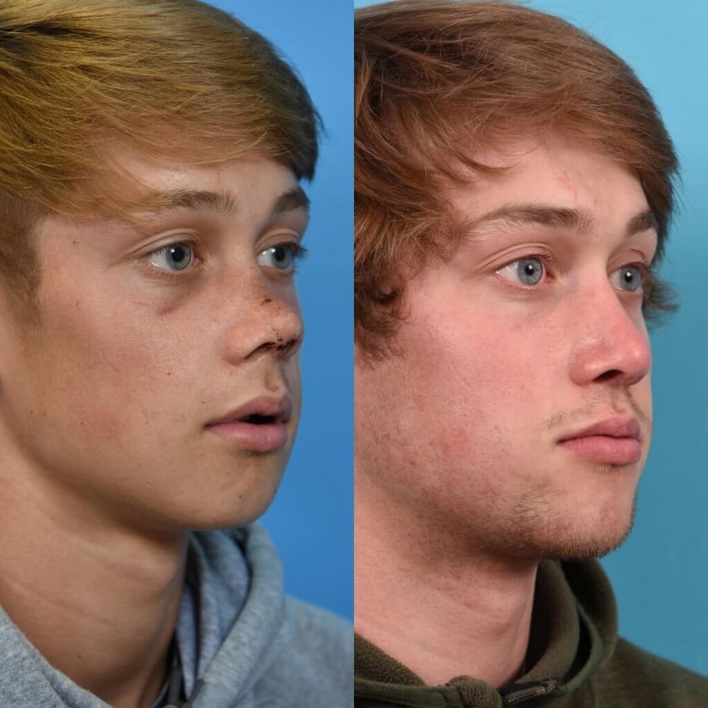 Male patient reconstruction surgery before and after.