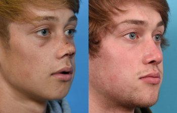Male patient reconstruction surgery before and after.