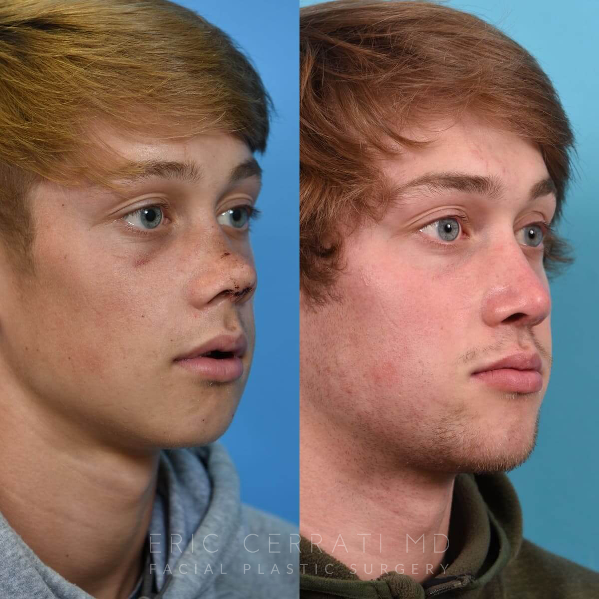 🥇 Salt Lake City UT Facial Reconstructive Surgery Before and After Pictures