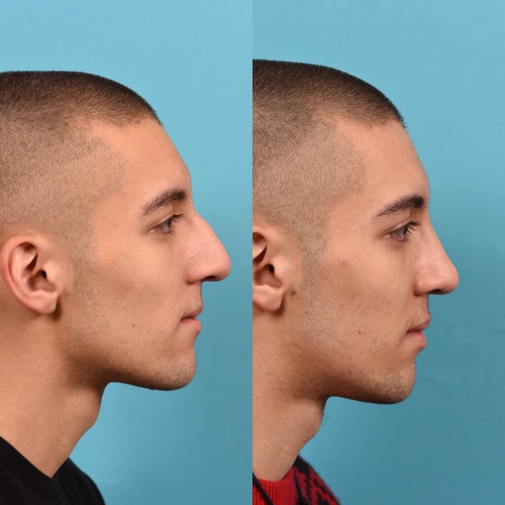 young male patient before and after rhinoplasty - right side