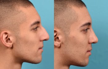 young male patient before and after rhinoplasty - right side