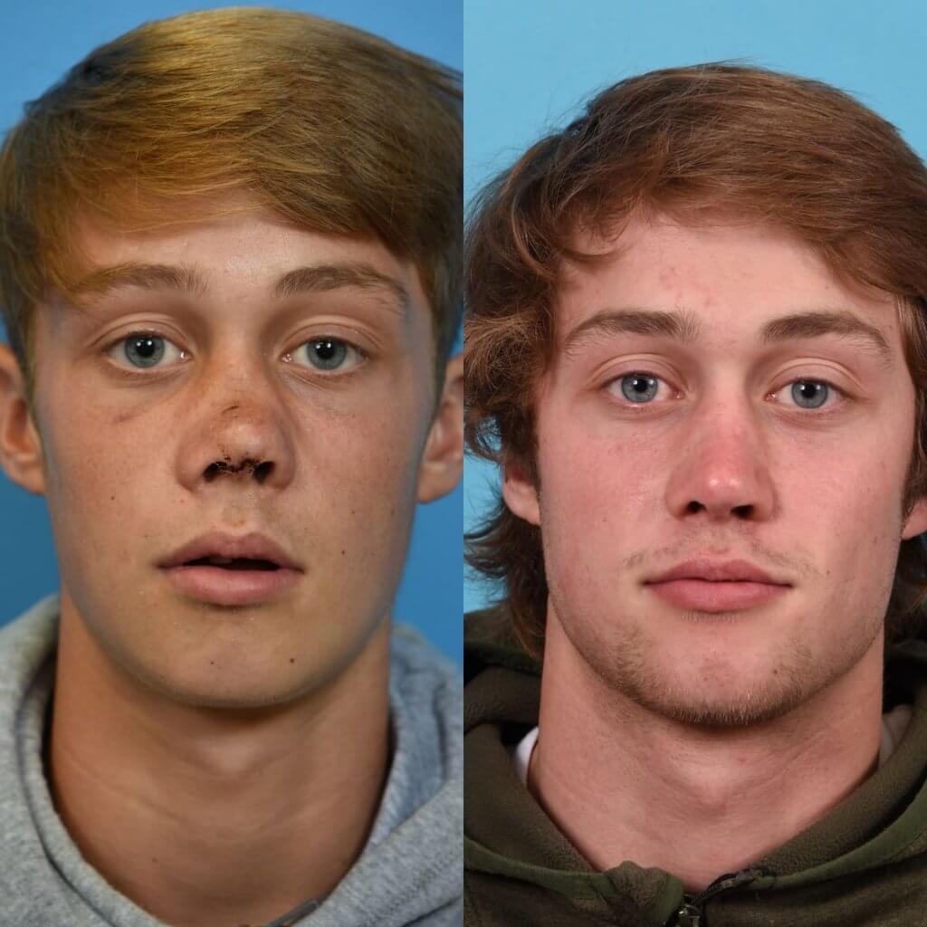 Male patient reconstruction surgery before and after.