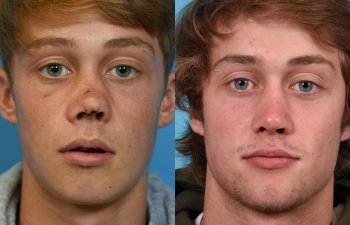 Male patient reconstruction surgery before and after.