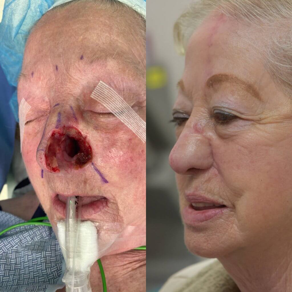 Old woman before and after reconstruction surgery.