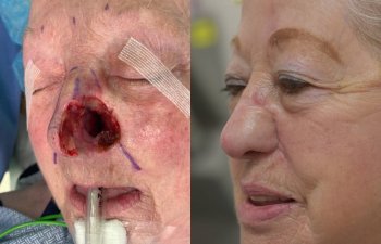 Old woman before and after reconstruction surgery.