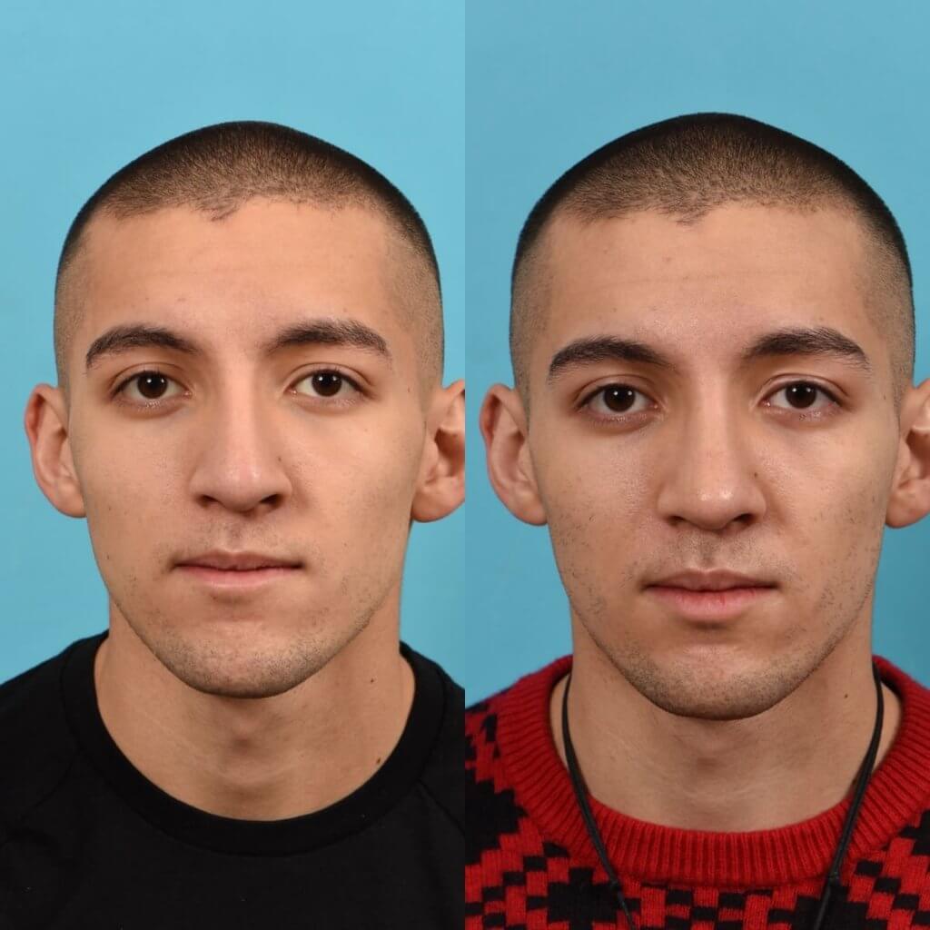 young male patient before and after rhinoplasty - front