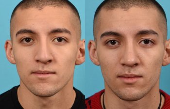 young male patient before and after rhinoplasty - front