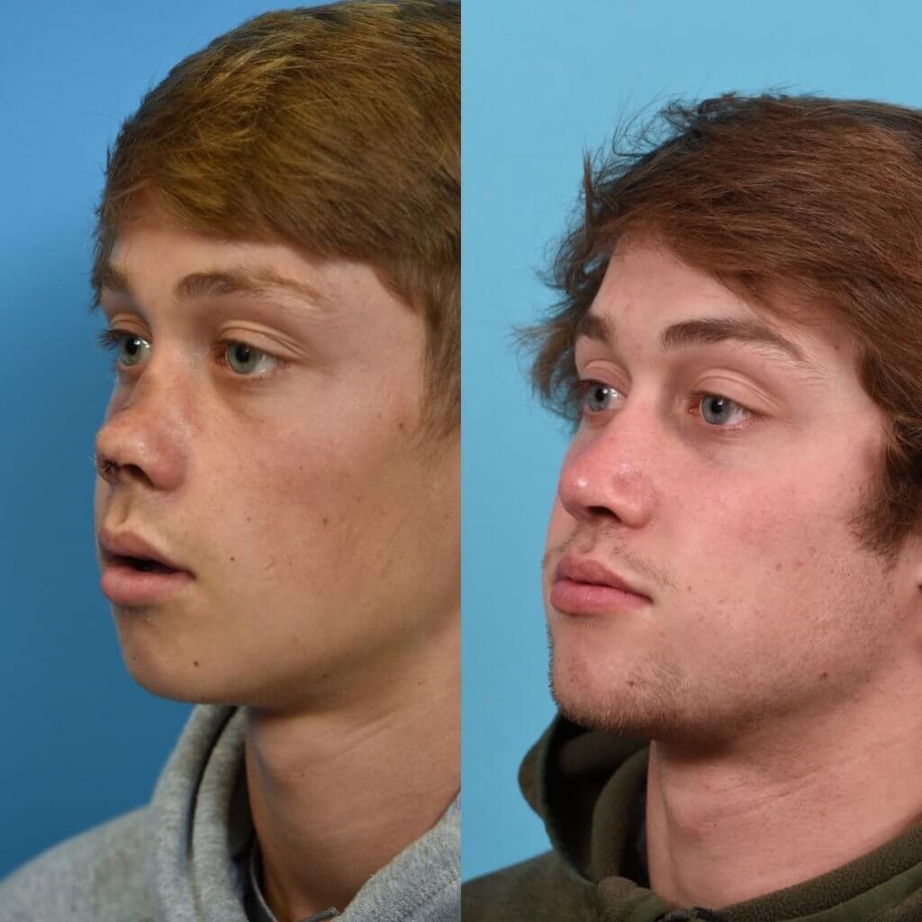Male patient reconstruction surgery before and after.
