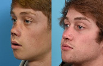 Male patient reconstruction surgery before and after.